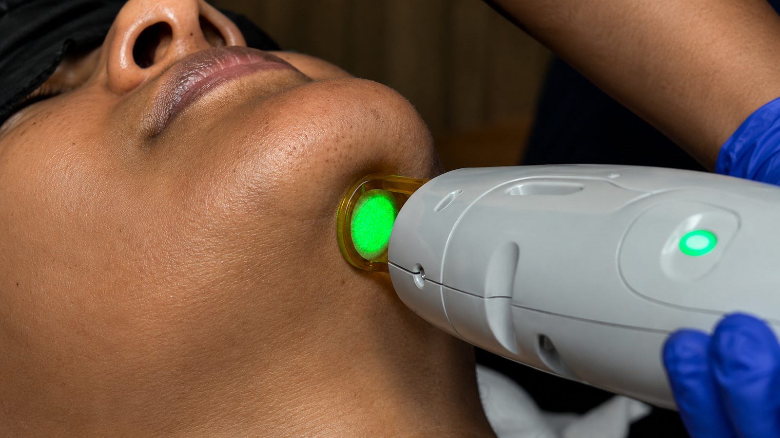 Laser hair removal on the chin and upper lip