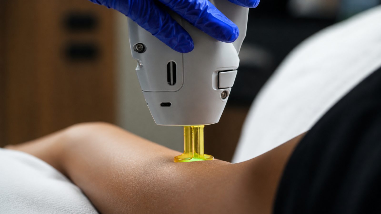 Laser hair removal on the forearm and hand