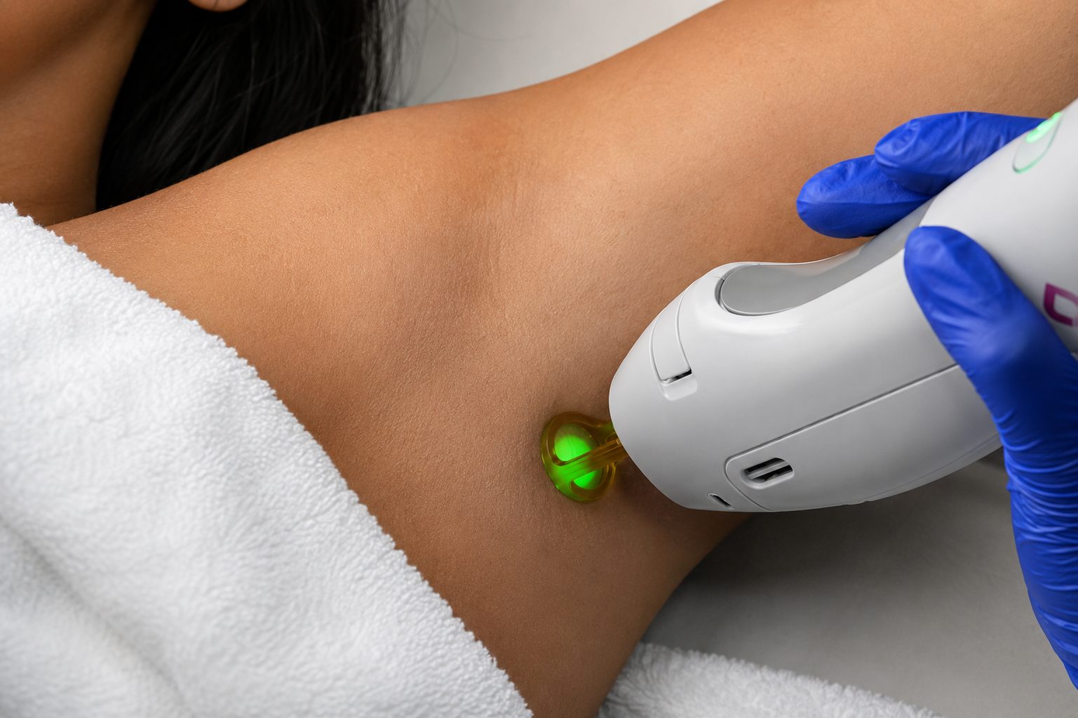 Laser hair removal on the underarm