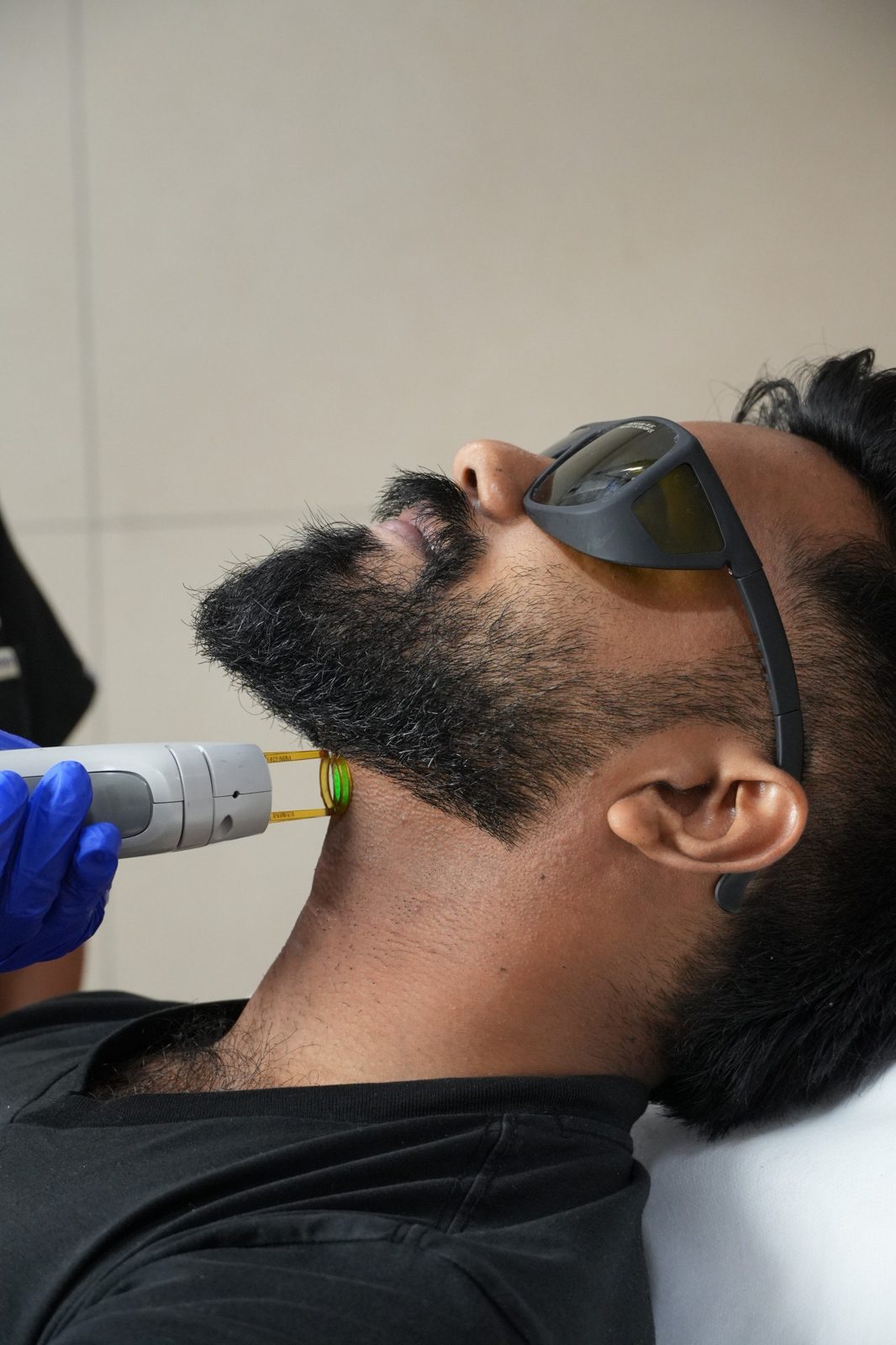 Laser hair removal along the beard and neckline