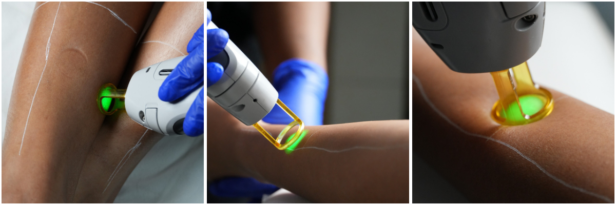 Laser Hair Treatment