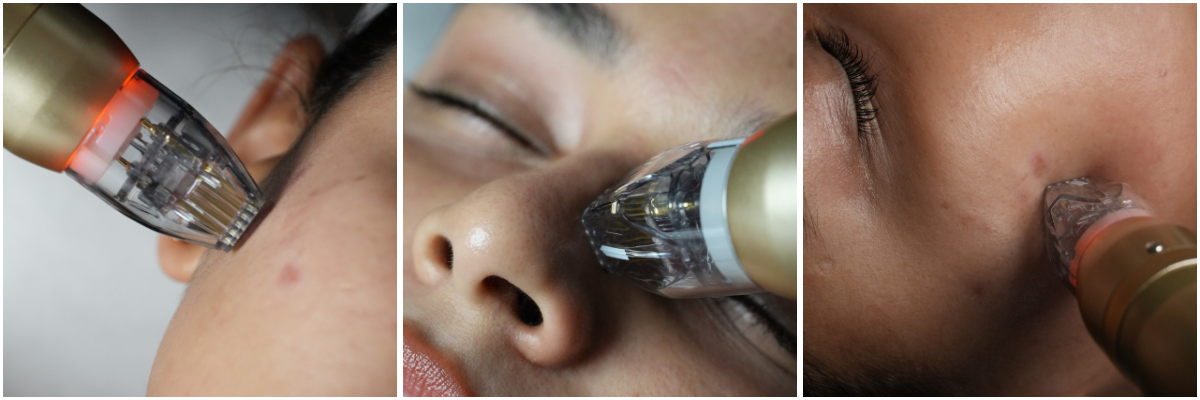 Microneedling