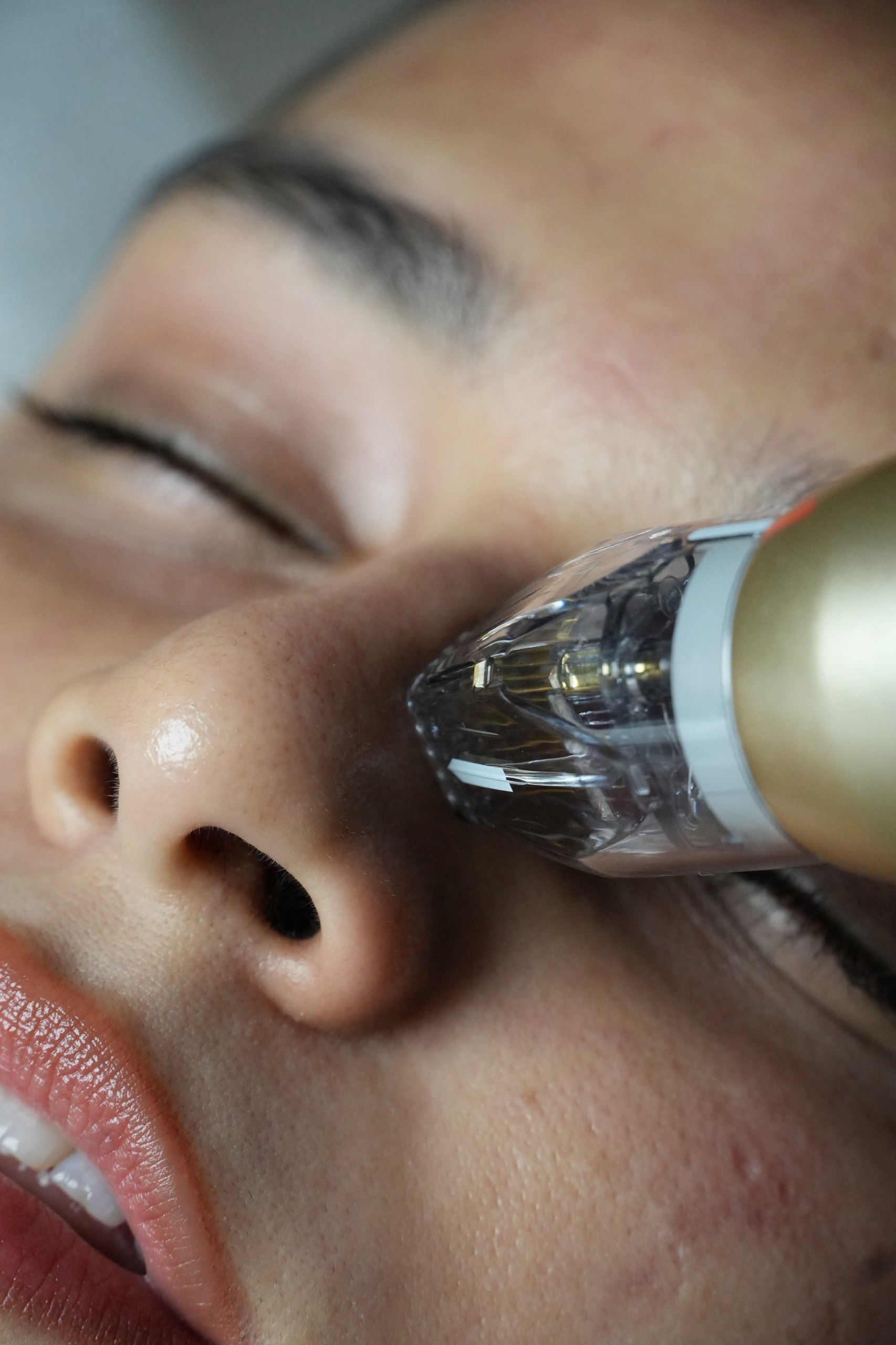 Does Microneedling Hurt
