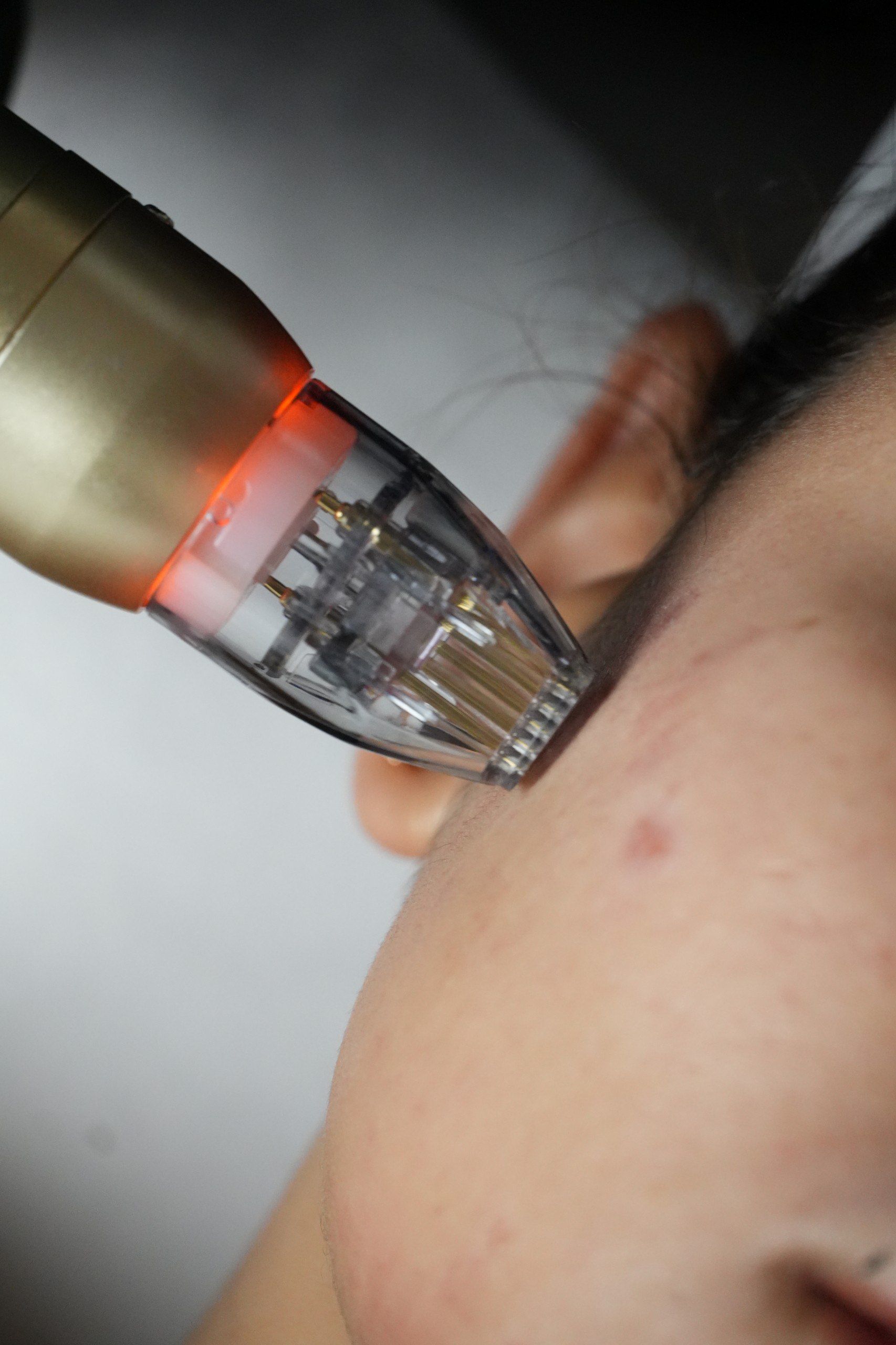 Microneedling